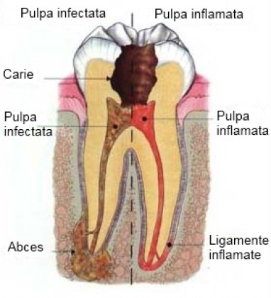 Tratamentul cariei dentare