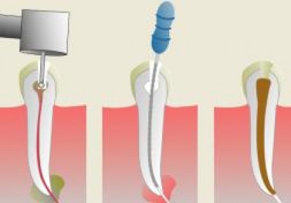 Tratamentul de canal